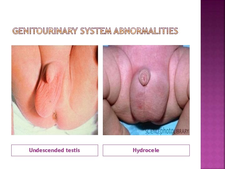 Undescended testis Hydrocele 