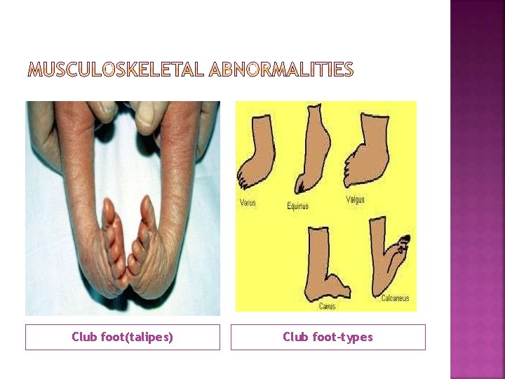 Club foot(talipes) Club foot-types 