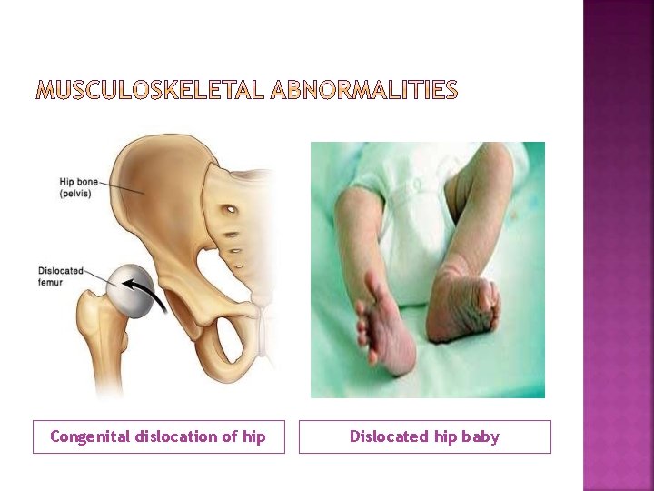 Congenital dislocation of hip Dislocated hip baby 