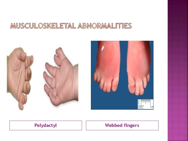 Polydactyl Webbed fingers 