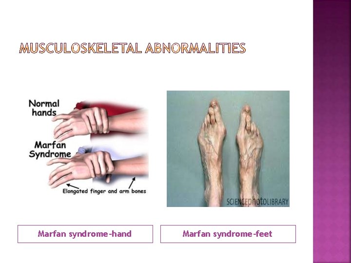 Marfan syndrome-hand Marfan syndrome-feet 