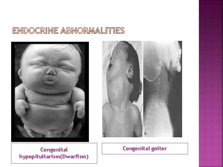 Congenital hypopituitarism(Dwarfism) Congenital goiter 