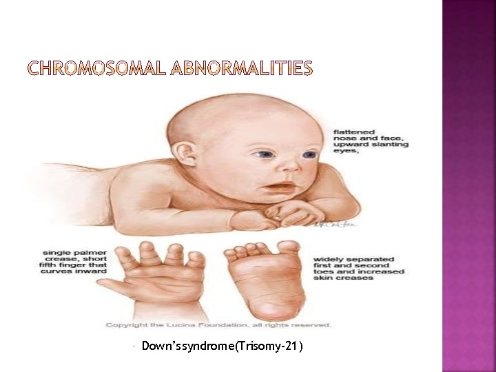  Down’s syndrome(Trisomy-21) 