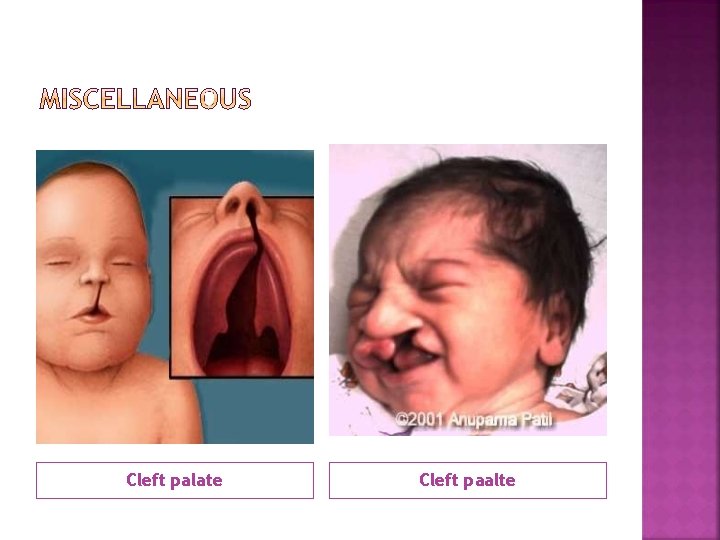 Cleft palate Cleft paalte 