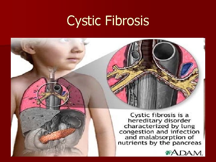Cystic Fibrosis 7 