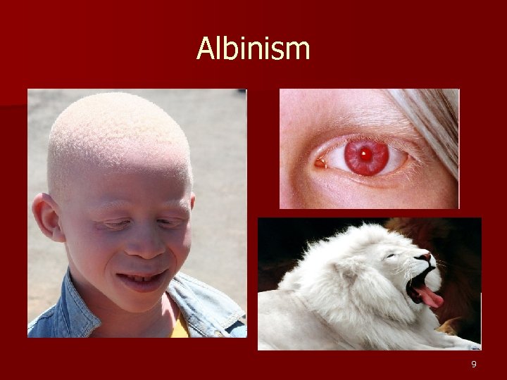 Albinism 9 