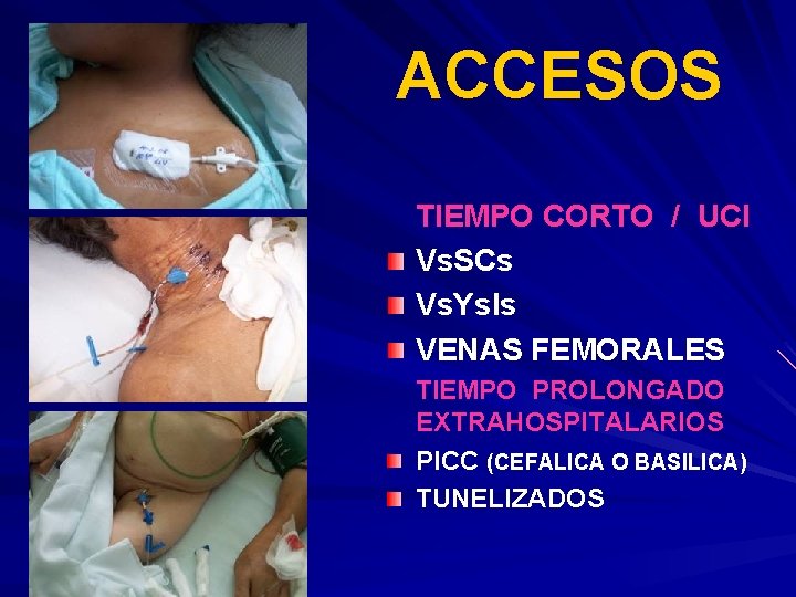 ACCESOS TIEMPO CORTO / UCI Vs. SCs Vs. Ys. Is VENAS FEMORALES TIEMPO PROLONGADO