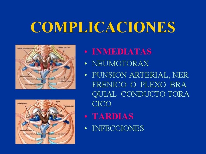 COMPLICACIONES • INMEDIATAS • NEUMOTORAX • PUNSION ARTERIAL, NER FRENICO O PLEXO BRA QUIAL