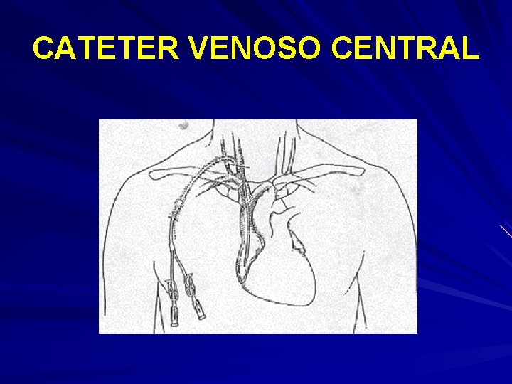 CATETER VENOSO CENTRAL 