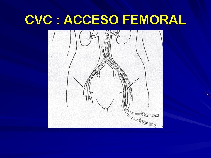 CVC : ACCESO FEMORAL 