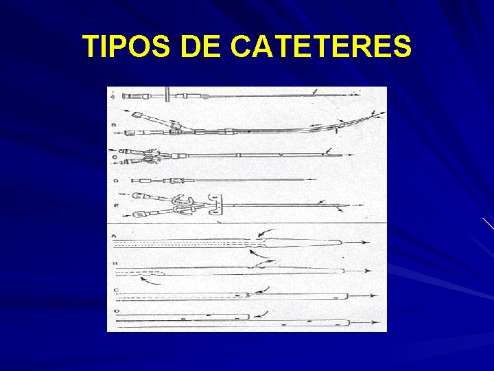 TIPOS DE CATETERES 