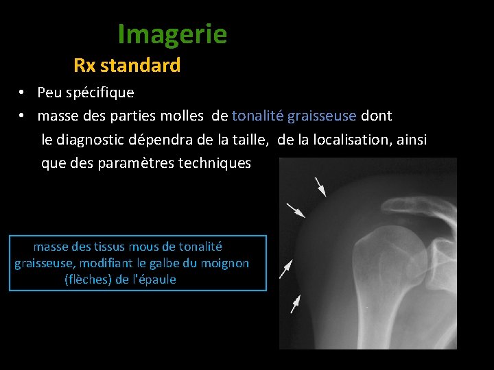 Imagerie Rx standard • Peu spécifique • masse des parties molles de tonalité graisseuse