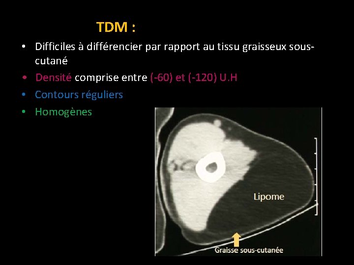 TDM : • Difficiles à différencier par rapport au tissu graisseux souscutané • Densité