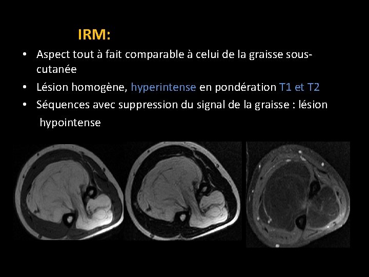 IRM: • Aspect tout à fait comparable à celui de la graisse souscutanée •