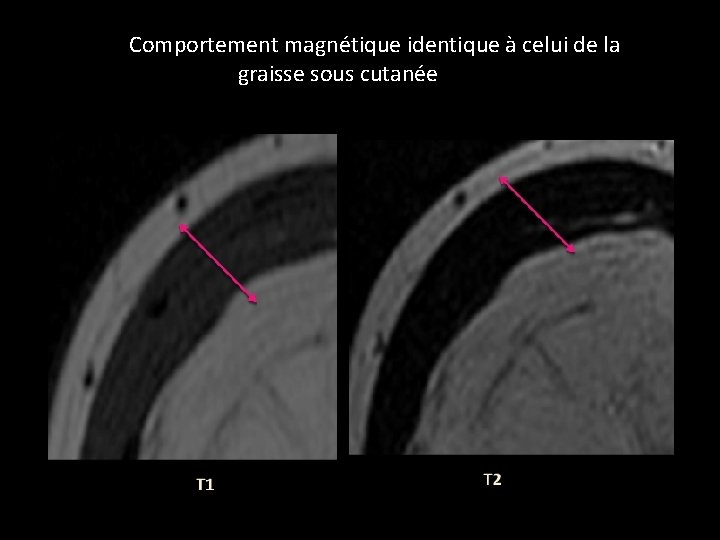 Comportement magnétique identique à celui de la graisse sous cutanée 