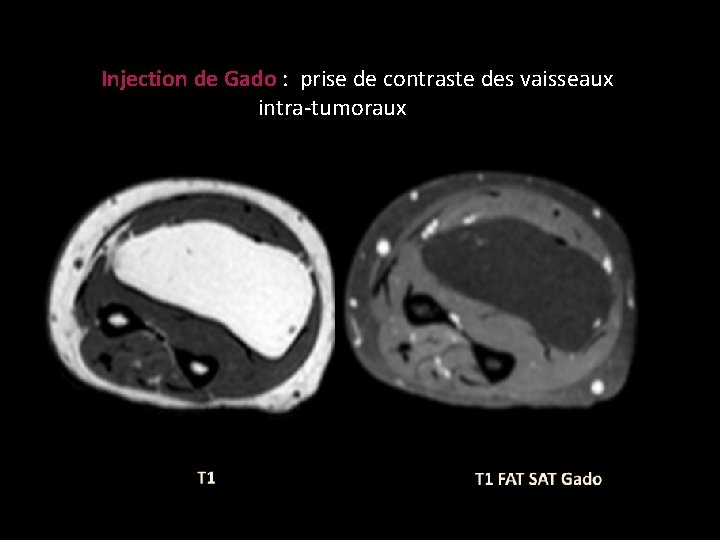 Injection de Gado : prise de contraste des vaisseaux intra-tumoraux 