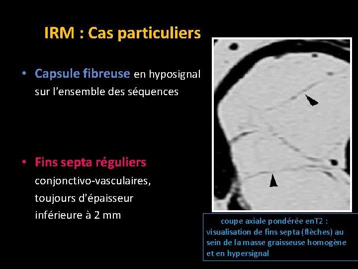 IRM : Cas particuliers • Capsule fibreuse en hyposignal sur l'ensemble des séquences •