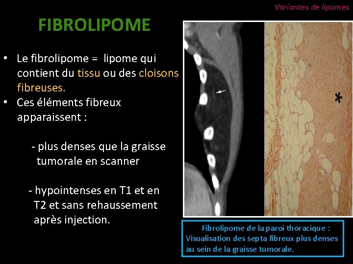 FIBROLIPOME Variantes de lipomes • Le fibrolipome = lipome qui contient du tissu ou