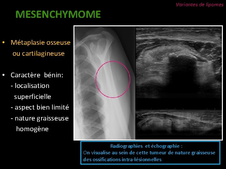 MESENCHYMOME Variantes de lipomes • Métaplasie osseuse ou cartilagineuse • Caractère bénin: - localisation