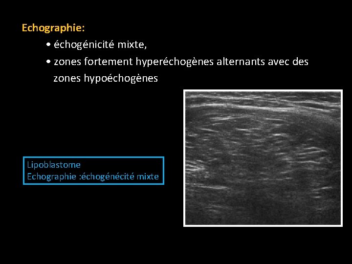 Echographie: • échogénicité mixte, • zones fortement hyperéchogènes alternants avec des zones hypoéchogènes Lipoblastome