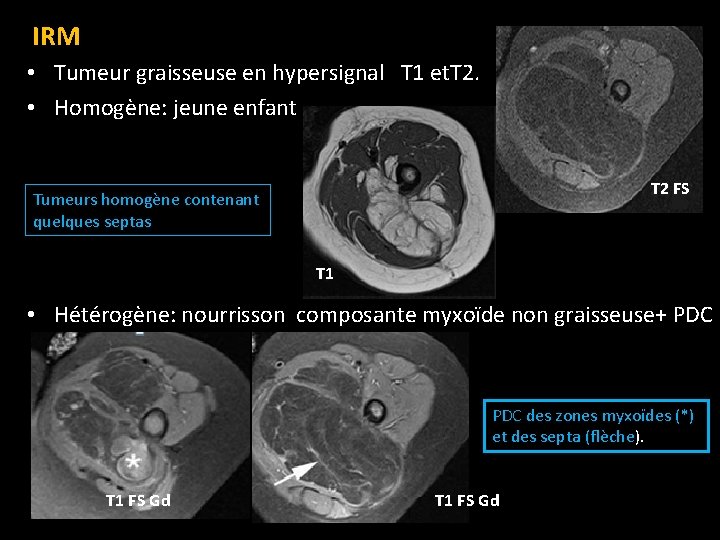 IRM • Tumeur graisseuse en hypersignal T 1 et. T 2. • Homogène: jeune