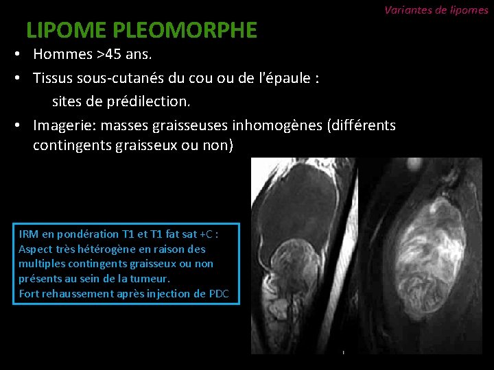 LIPOME PLEOMORPHE Variantes de lipomes • Hommes >45 ans. • Tissus sous-cutanés du cou