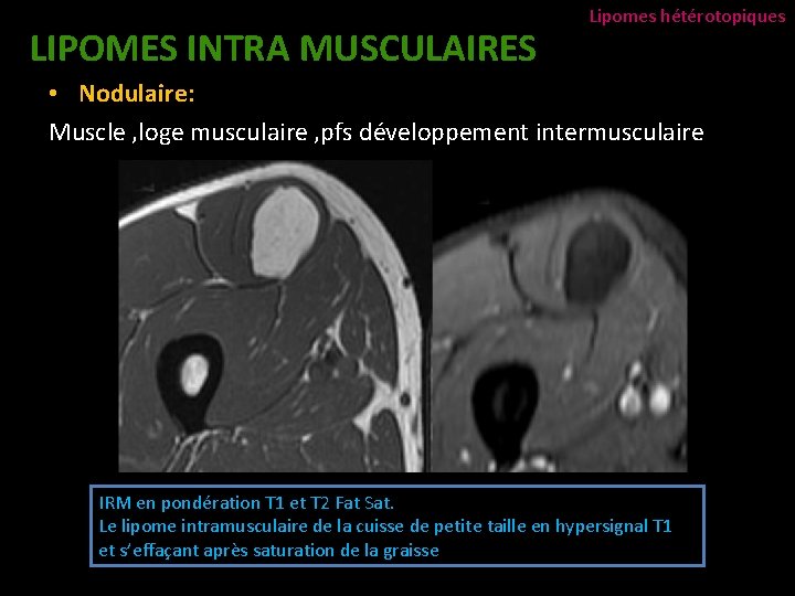 LIPOMES INTRA MUSCULAIRES Lipomes hétérotopiques • Nodulaire: Muscle , loge musculaire , pfs développement