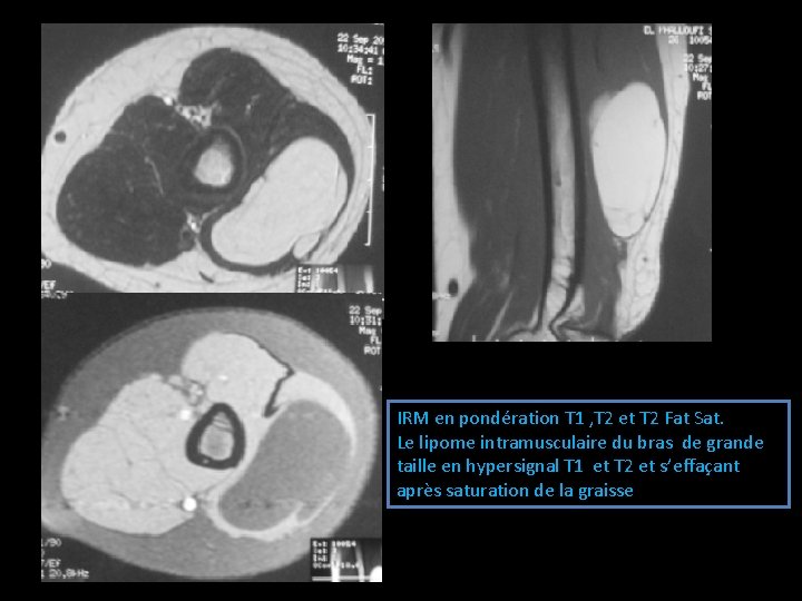 IRM en pondération T 1 , T 2 et T 2 Fat Sat. Le