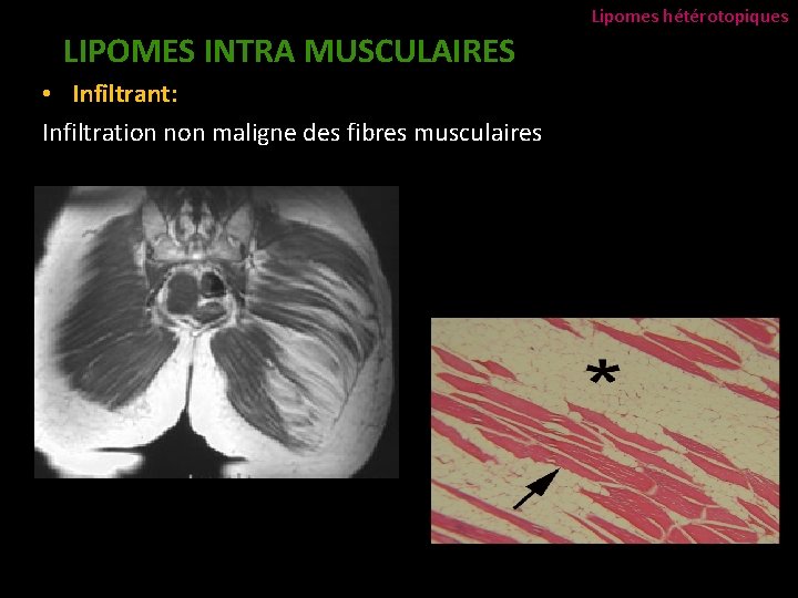 Lipomes hétérotopiques LIPOMES INTRA MUSCULAIRES • Infiltrant: Infiltration non maligne des fibres musculaires 