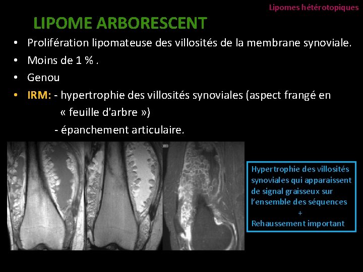 LIPOME ARBORESCENT • • Lipomes hétérotopiques Prolifération lipomateuse des villosités de la membrane synoviale.