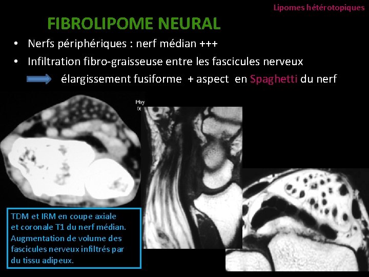 FIBROLIPOME NEURAL Lipomes hétérotopiques • Nerfs périphériques : nerf médian +++ • Infiltration fibro-graisseuse
