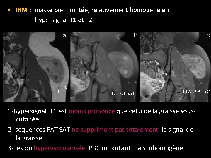  • IRM : masse bien limitée, relativement homogène en hypersignal T 1 et