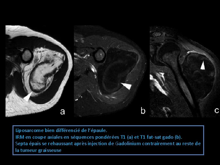 Liposarcome bien différencié de l’épaule. IRM en coupe axiales en séquences pondérées T 1