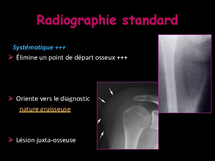 Radiographie standard Systématique +++ Ø Élimine un point de départ osseux +++ Ø Oriente