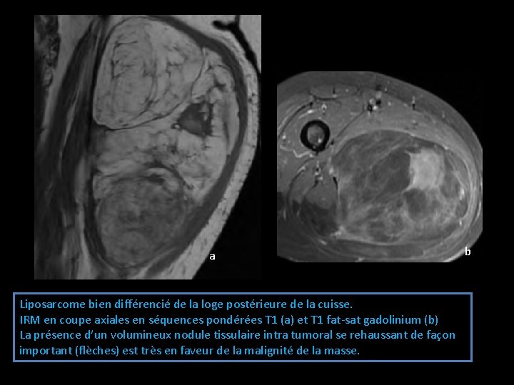 a Liposarcome bien différencié de la loge postérieure de la cuisse. IRM en coupe