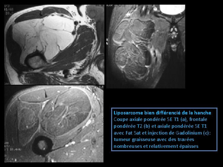 Liposarcome bien différencié de la hanche Coupe axiale pondérée SE T 1 (a), frontale