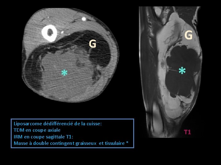 Liposarcome dédifférencié de la cuisse: TDM en coupe axiale IRM en coupe sagittale T