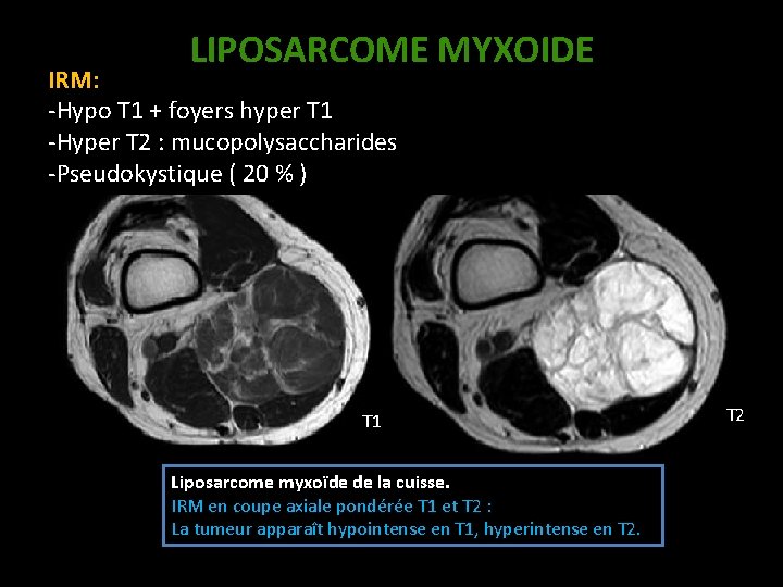 LIPOSARCOME MYXOIDE IRM: -Hypo T 1 + foyers hyper T 1 -Hyper T 2