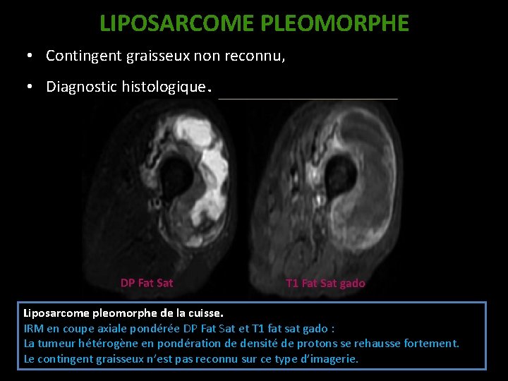 LIPOSARCOME PLEOMORPHE • Contingent graisseux non reconnu, • Diagnostic histologique. Liposarcome pleomorphe de la