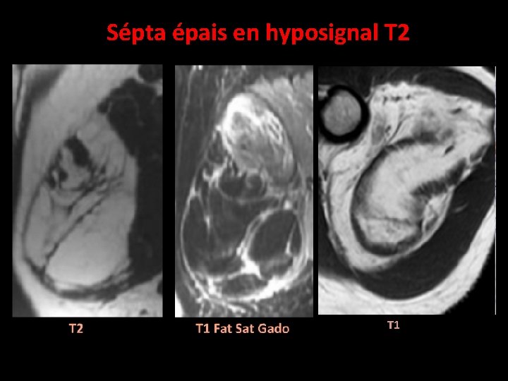 Sépta épais en hyposignal T 2 T 1 