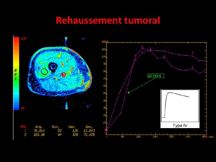 Rehaussement tumoral 