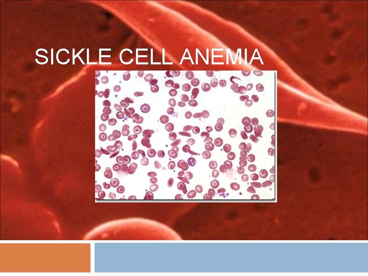 SICKLE CELL ANEMIA 