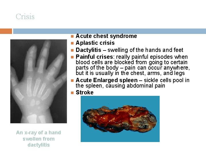 Crisis An x-ray of a hand swollen from dactylitis Acute chest syndrome Aplastic crisis