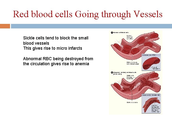 Red blood cells Going through Vessels Sickle cells tend to block the small blood