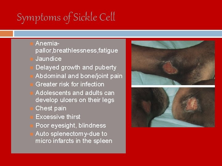 Symptoms of Sickle Cell Anemiapallor, breathlessness, fatigue Jaundice Delayed growth and puberty Abdominal and