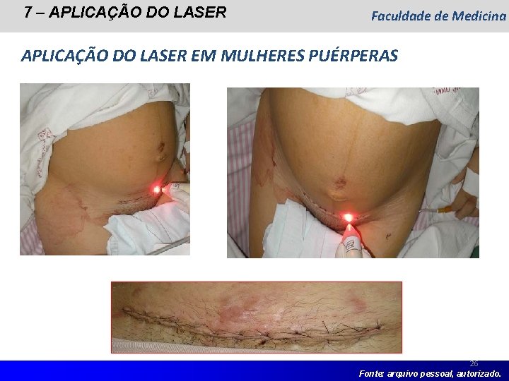 7 – APLICAÇÃO DO LASER Faculdade de Medicina APLICAÇÃO DO LASER EM MULHERES PUÉRPERAS 7 – APLICAÇÃO DO LASER Faculdade de Medicina APLICAÇÃO DO LASER EM MULHERES PUÉRPERAS