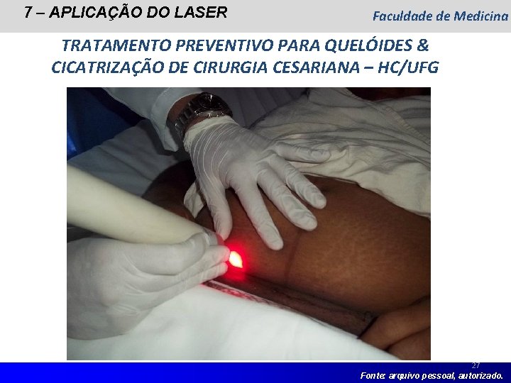 7 – APLICAÇÃO DO LASER Faculdade de Medicina TRATAMENTO PREVENTIVO PARA QUELÓIDES & CICATRIZAÇÃO 7 – APLICAÇÃO DO LASER Faculdade de Medicina TRATAMENTO PREVENTIVO PARA QUELÓIDES & CICATRIZAÇÃO