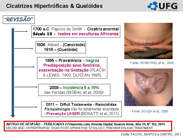 Cicatrizes Hipertróficas & Quelóides ‘’REVISÃO’’ 1700 a. C: Papiros de Smith - Cicatriz anormal Cicatrizes Hipertróficas & Quelóides ‘’REVISÃO’’ 1700 a. C: Papiros de Smith - Cicatriz anormal