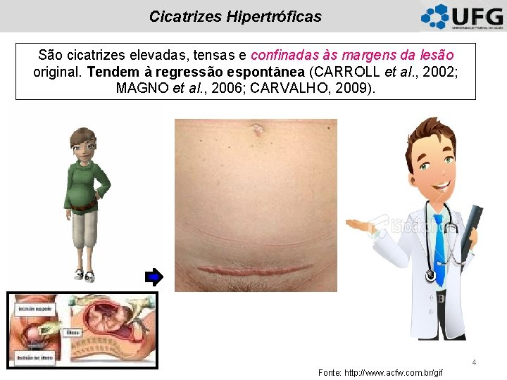 Cicatrizes Hipertróficas São cicatrizes elevadas, tensas e confinadas às margens da lesão original. Tendem Cicatrizes Hipertróficas São cicatrizes elevadas, tensas e confinadas às margens da lesão original. Tendem