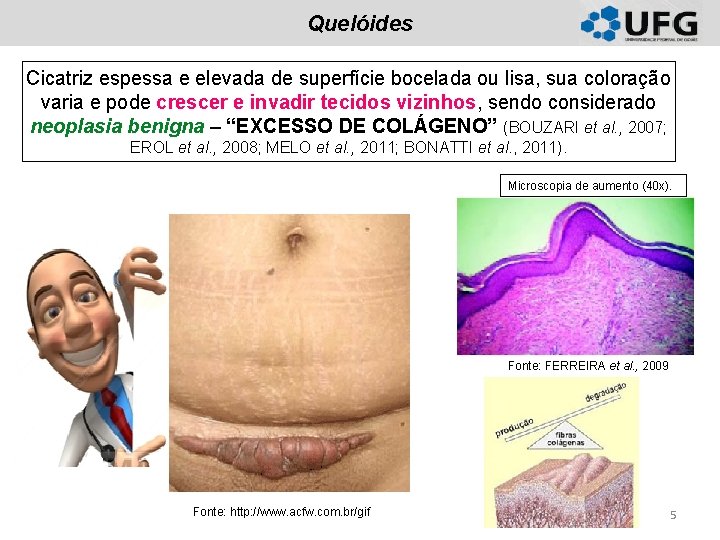 Quelóides Cicatriz espessa e elevada de superfície bocelada ou lisa, sua coloração varia e Quelóides Cicatriz espessa e elevada de superfície bocelada ou lisa, sua coloração varia e